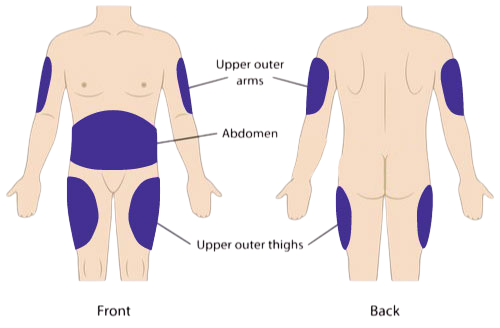 Where to Inject Mounjaro Image Where to Inject Mounjaro Image